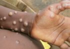 3 cas de monkeypox détectés à Kinshasa 