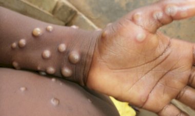 3 cas de monkeypox détectés à Kinshasa