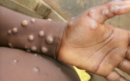 3 cas de monkeypox détectés à Kinshasa 