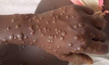 MPOX : l'épidémie prend de l'ampleur à Kinshasa, déjà 2 morts enregistrés