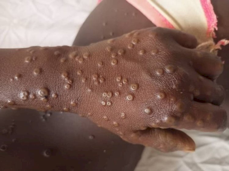 MPOX : l'épidémie prend de l'ampleur à Kinshasa, déjà 2 morts enregistrés 